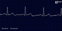 Analyzing biosignals using Artificial Intelligence